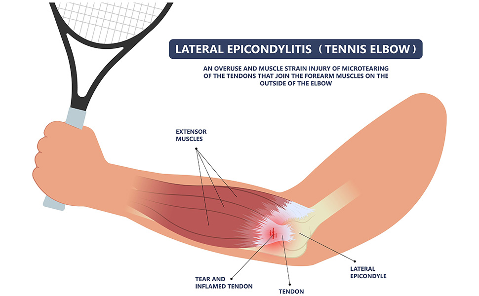 Tennis Elbow Diagram
