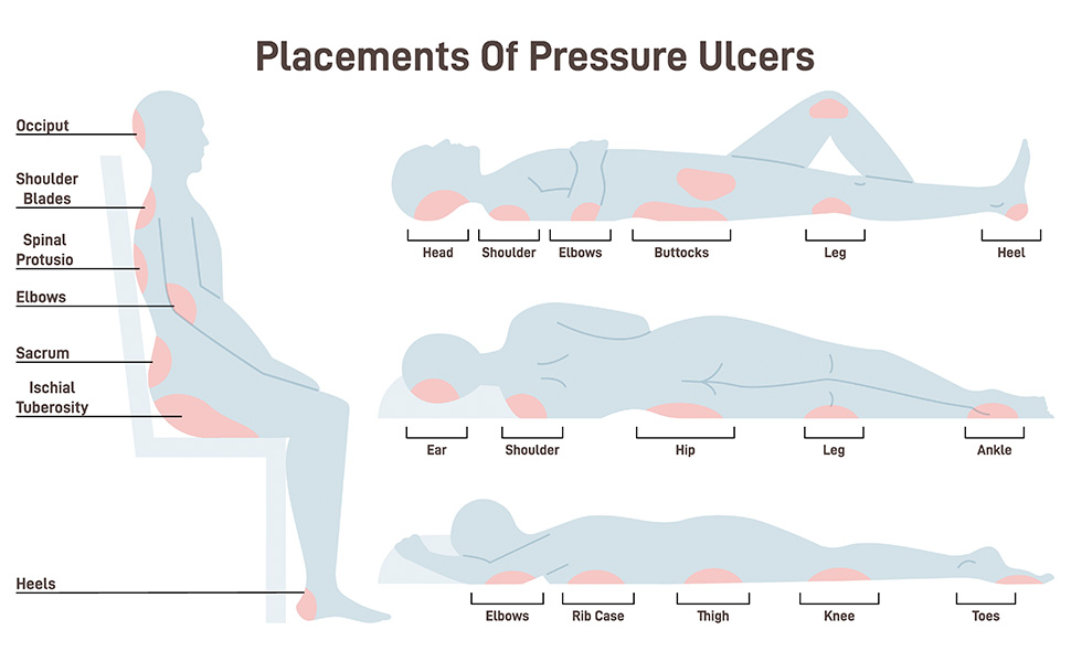 Pressure Sore Locations