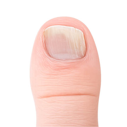 Stage 1