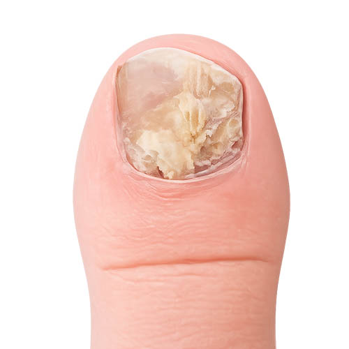 Stage 3