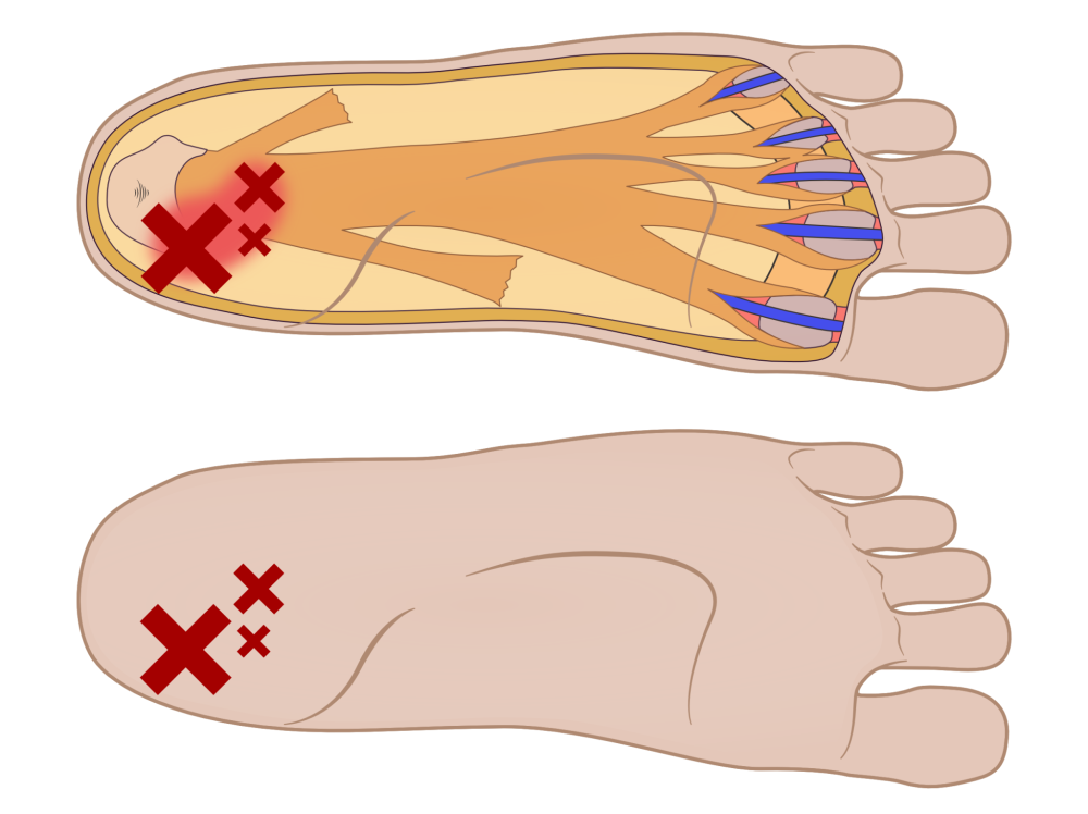 HeelFixKit for Heel pain