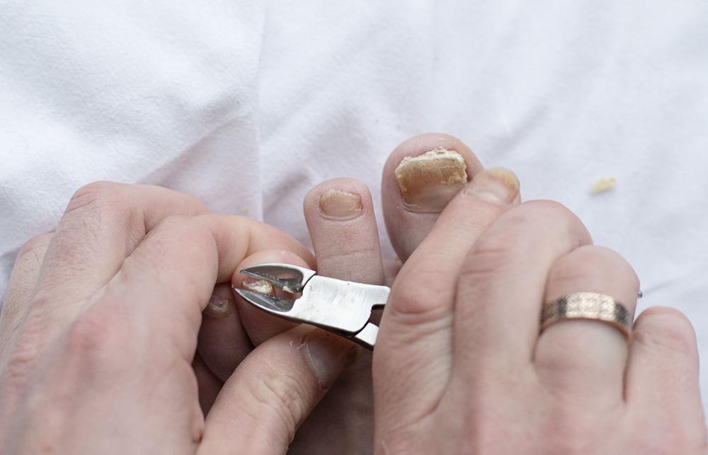 Cutting Fungal Nail with Nippers