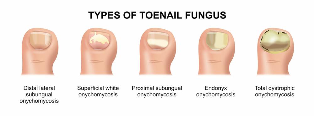Toe Nail Infection Types