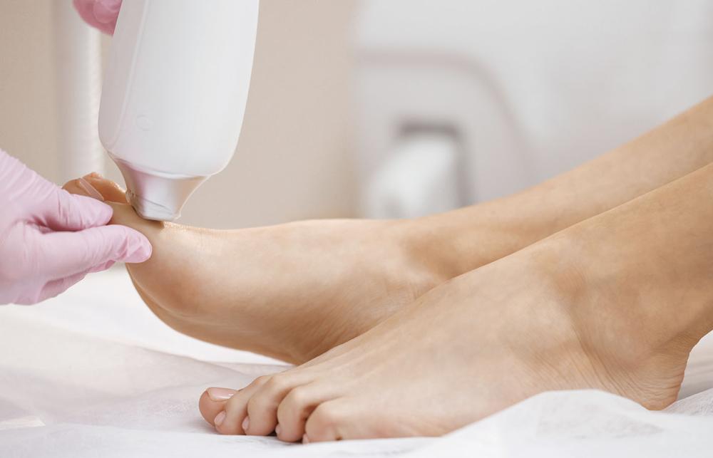 Laser Treatment for Fungal Nail