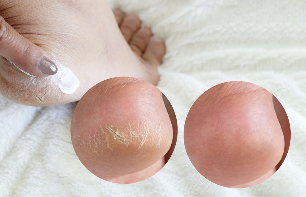 Foot Cream - Before and After