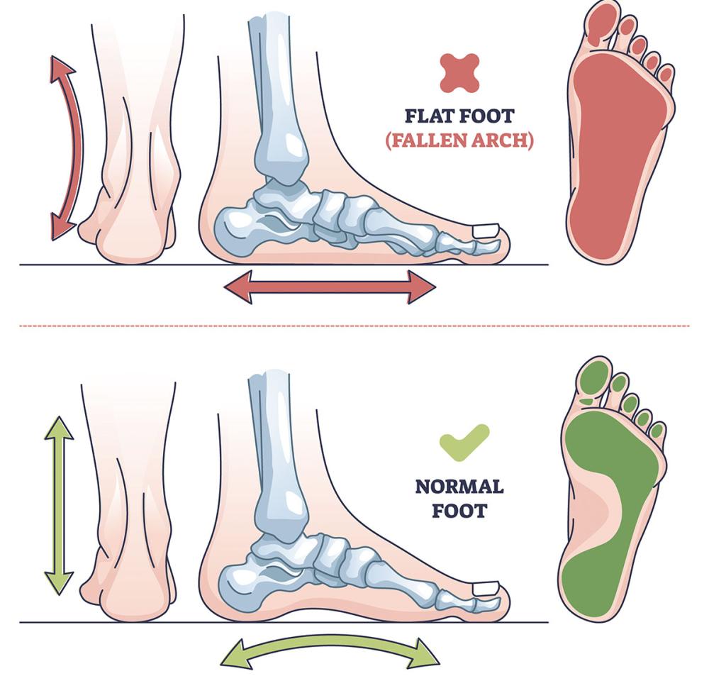Foot Types
