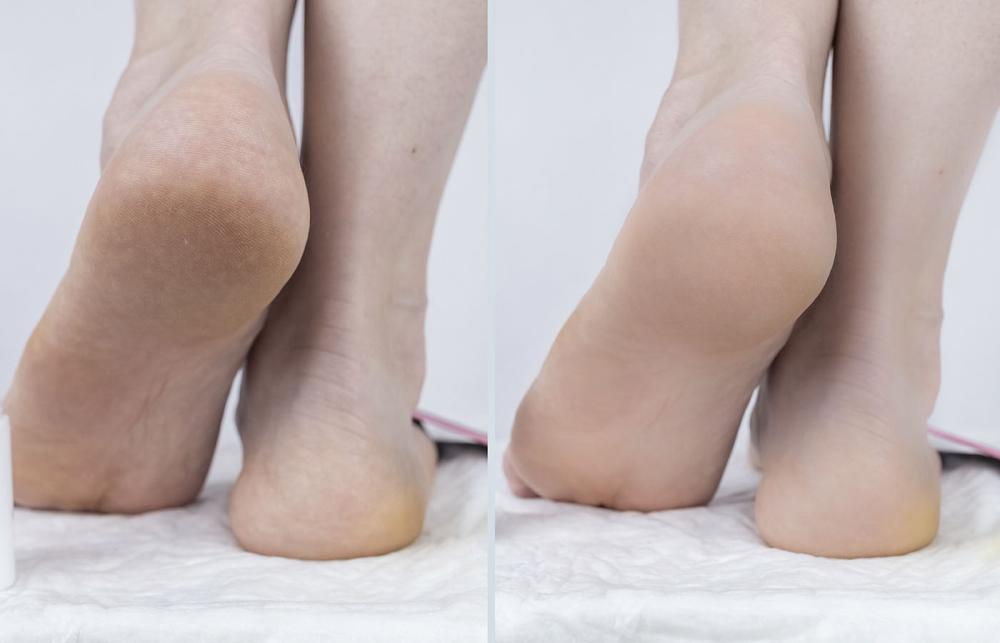 Urea Foot Cream being applied 