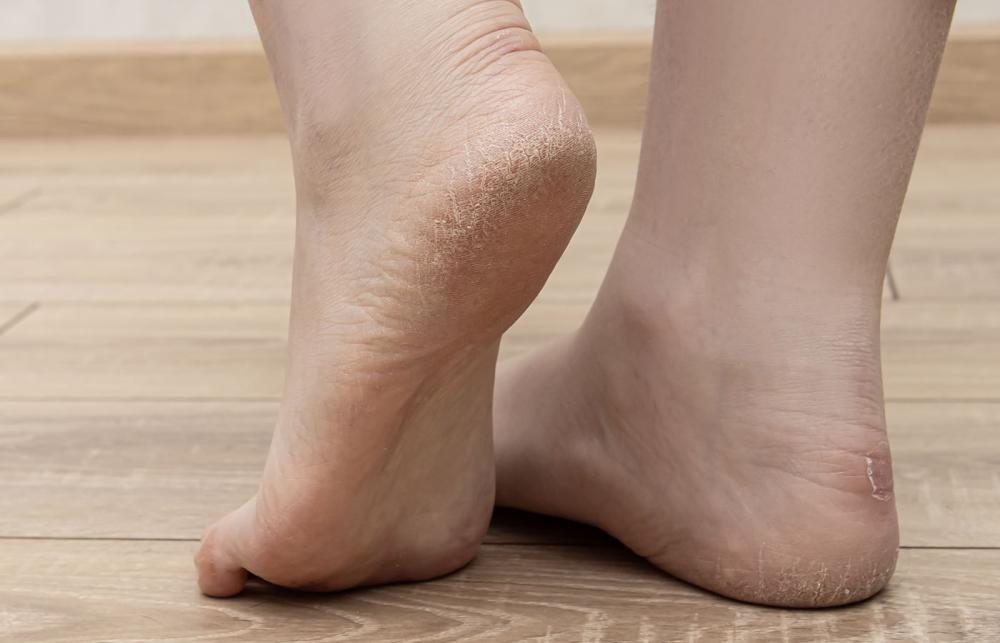 Dry Heels