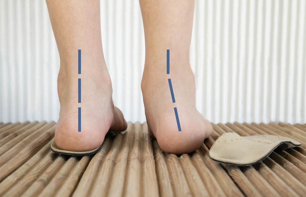 Pronated Feet
