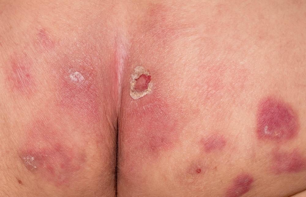 Pressure Sores on Buttocks 