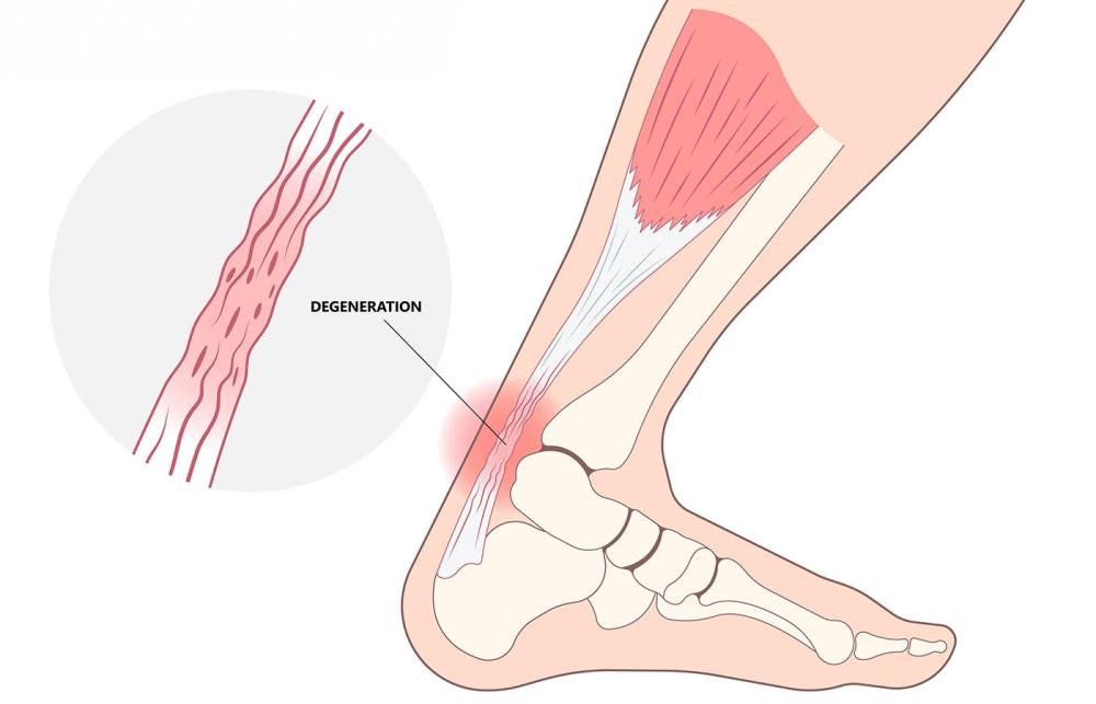Illustration of Achilles tendinopathy and tendon irritation