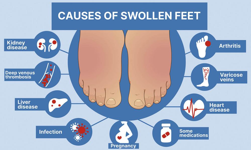 Causes of Swollen Feet