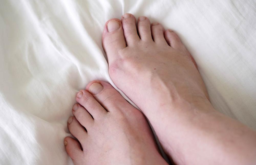 Swollen Feet