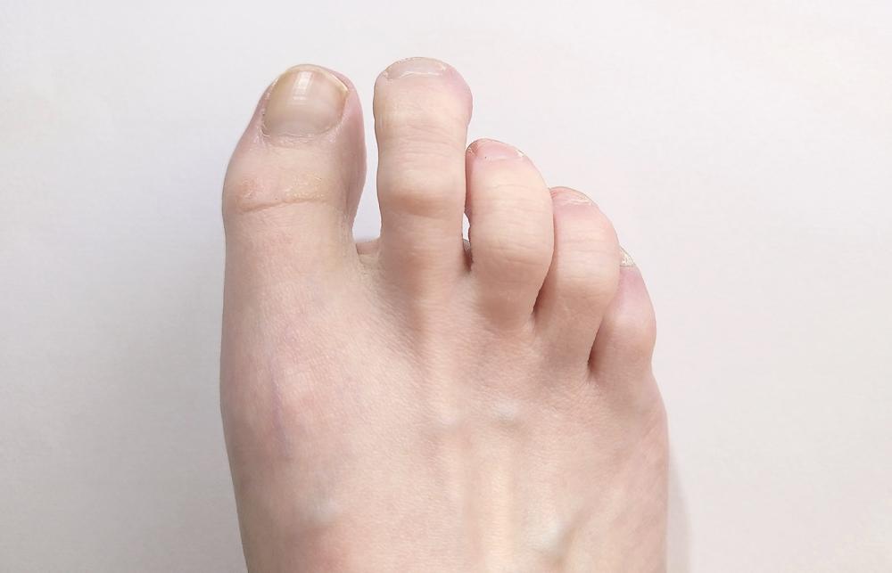 Hammer Toes