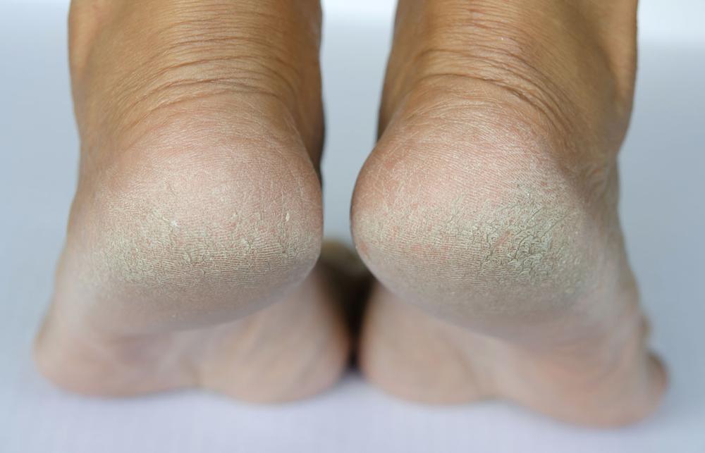 Person Standing with Cracked Heels