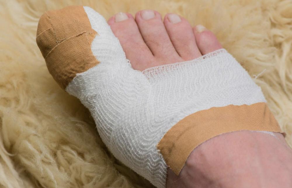 Foot After Surgery 