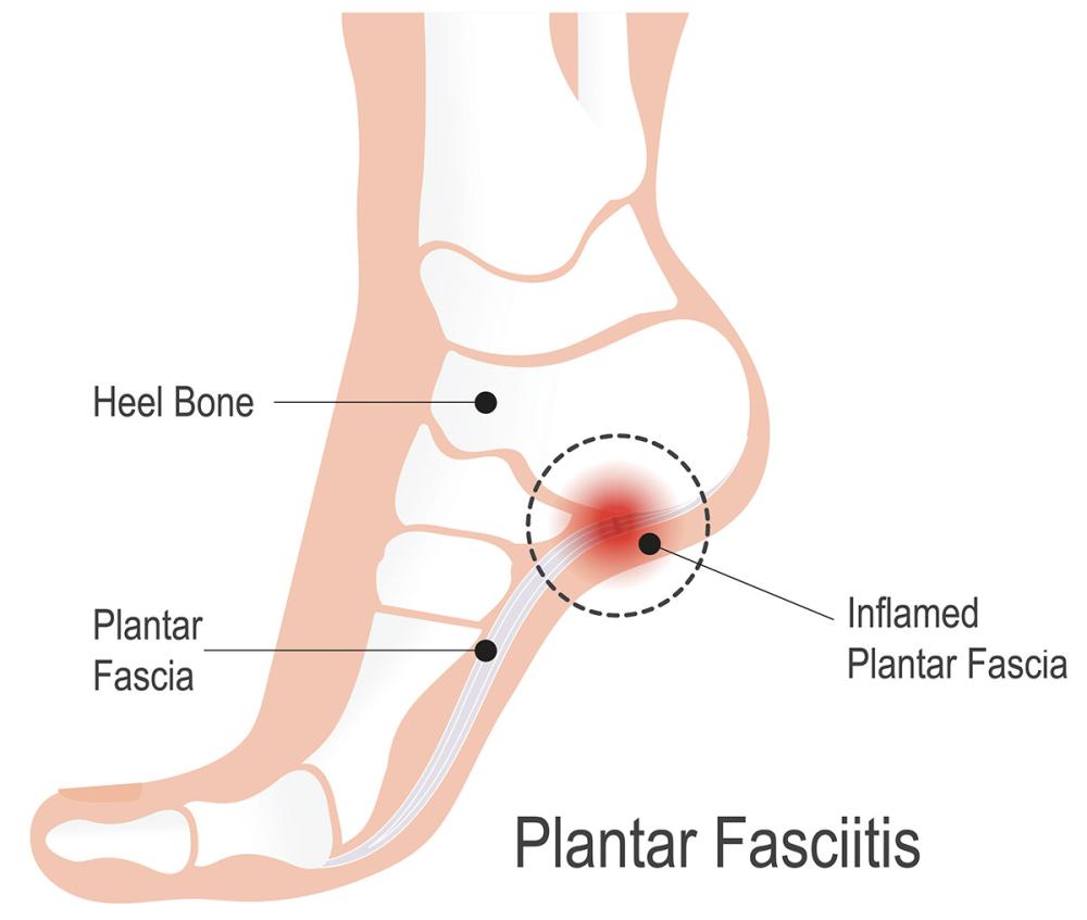 Illustration showing plantar fasciitis heel pain and plantar fascia strain