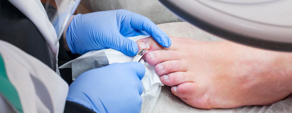 Ingrown Toenail Treatment