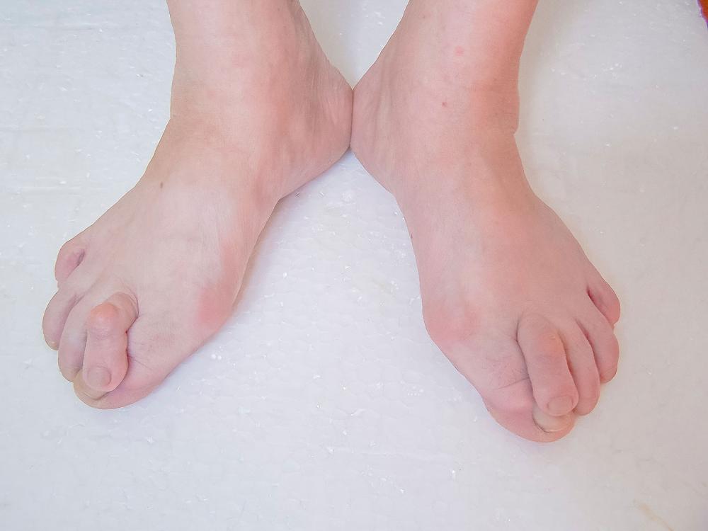 Overlapping Toes