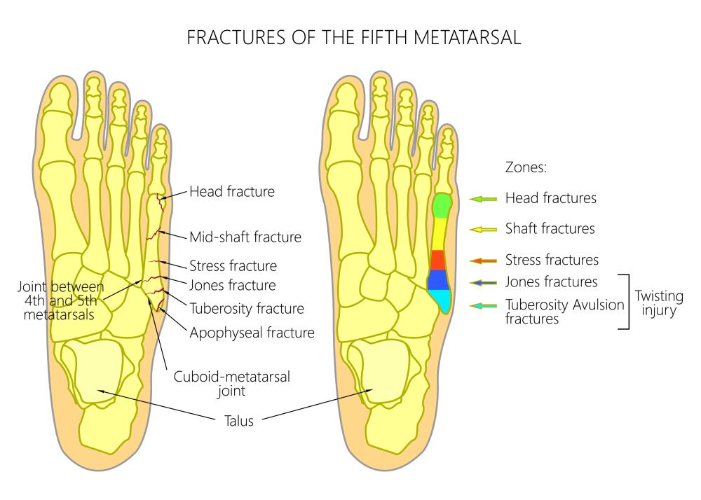 broken metatarsal 5
