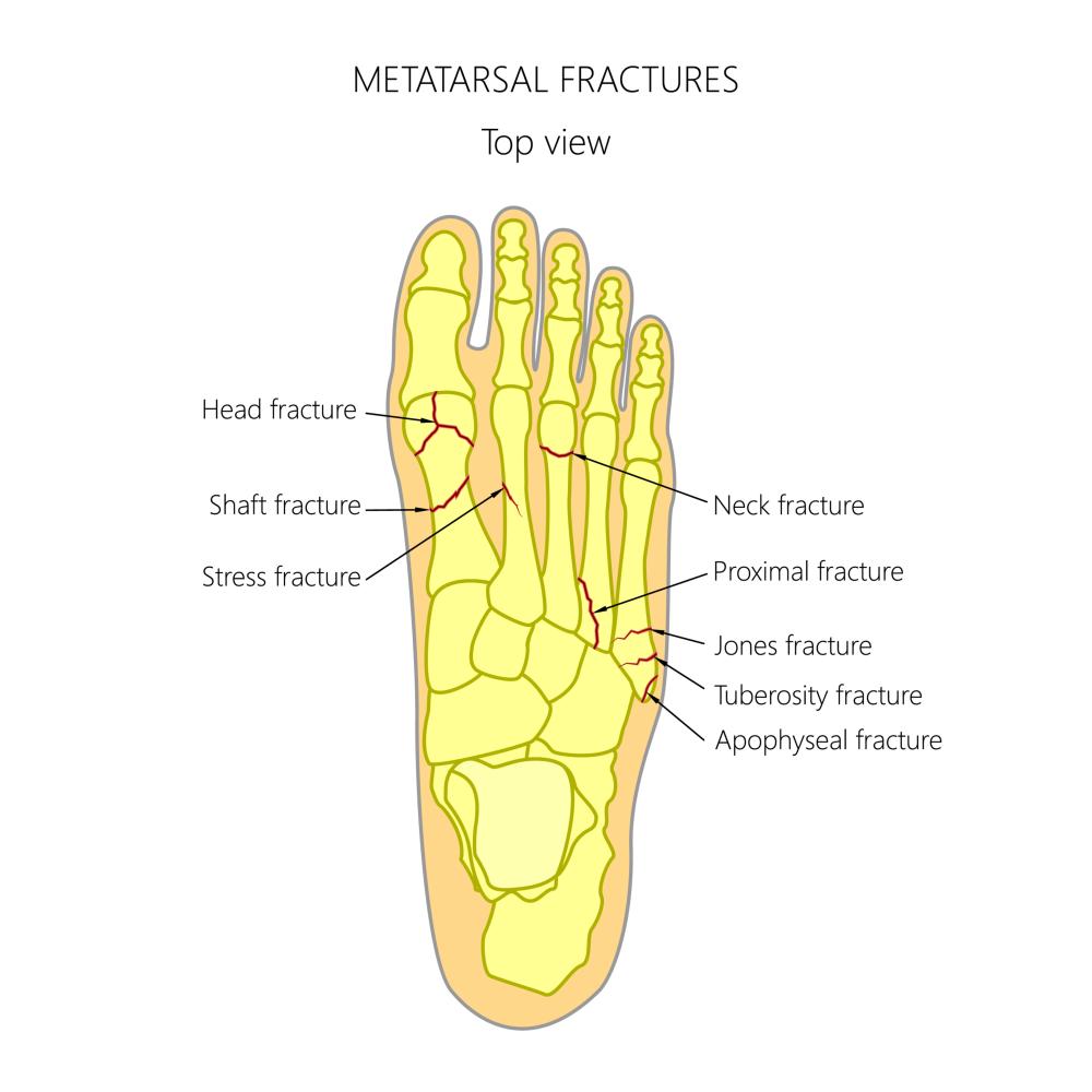 broken metatarsal 5