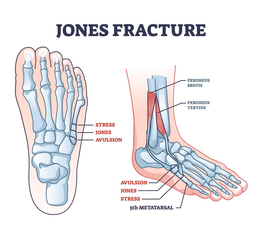 broken metatarsal 5