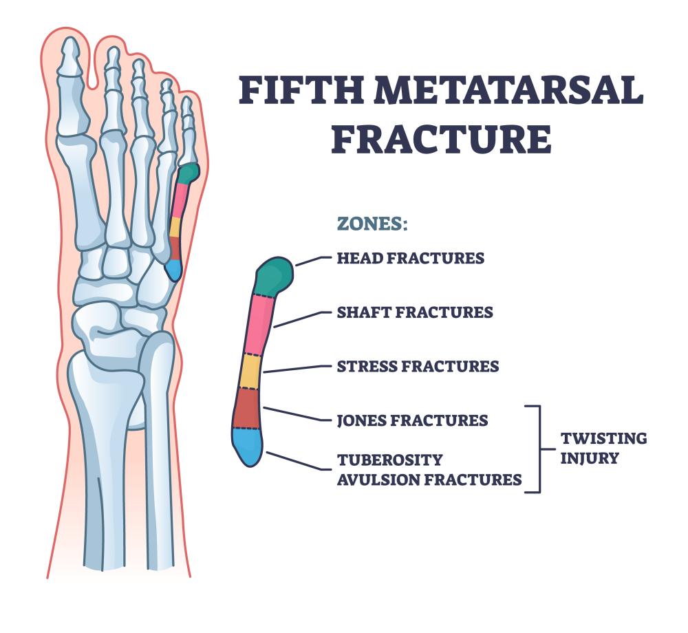 metatarsal 5