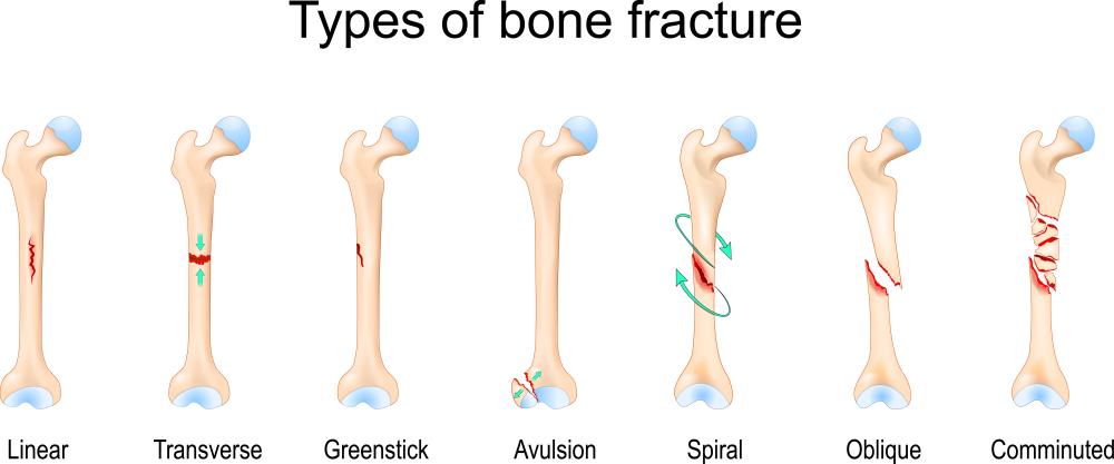 fracture foot