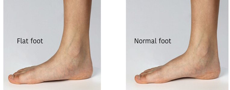 Flat Feet Identified