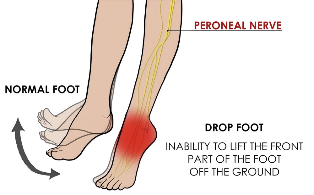 Foot Drop Explained