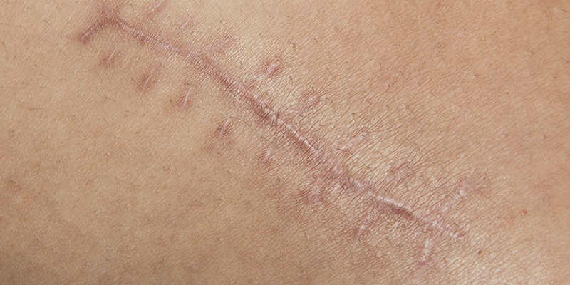 Scar After Stitches 