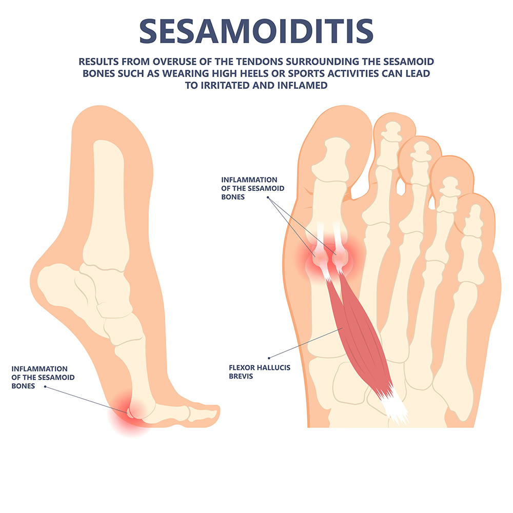 Sesamoiditis Diagram