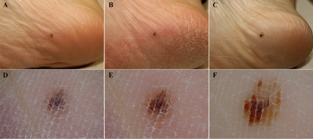 Dermatoscope
