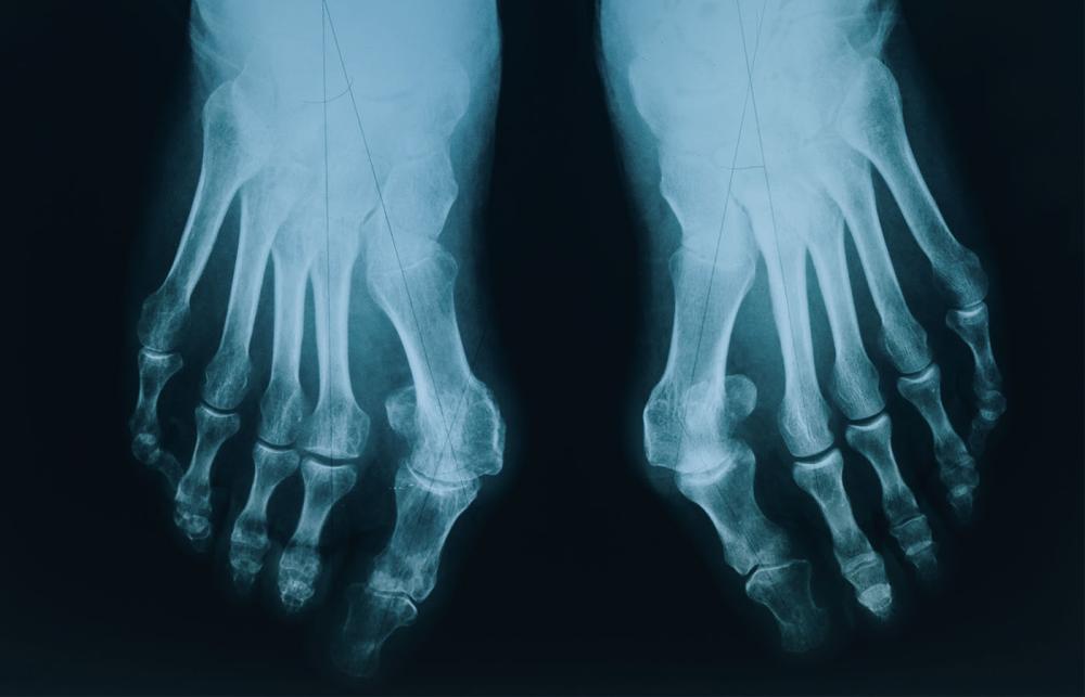 Rheumatoid Arthritis Of the Foot