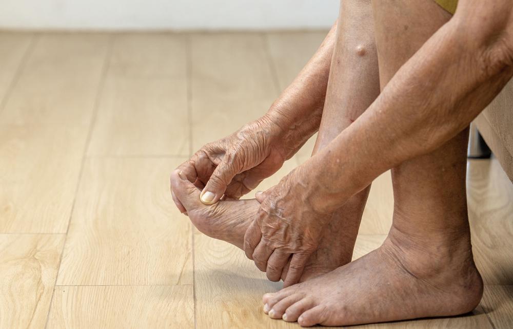 Rheumatoid Arthritis Of the Foot