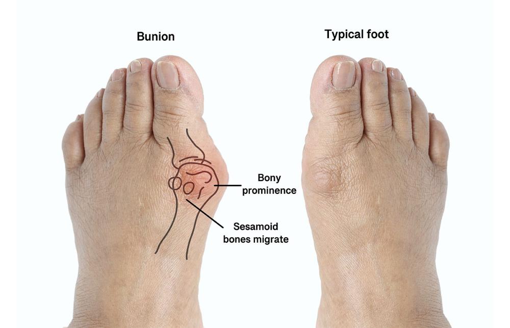 How Bunions from Under Skin