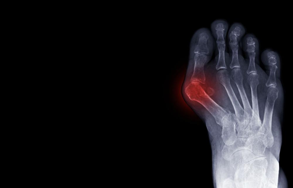 Bunion Xray
