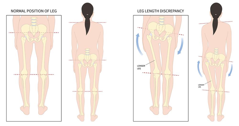 Leg Length Discrepancy 