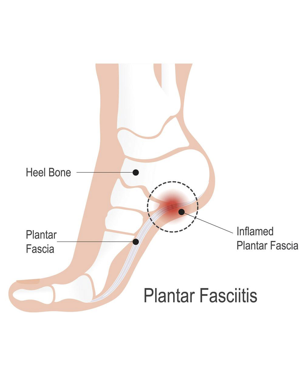 Illustration showing plantar fasciitis heel pain and plantar fascia strain