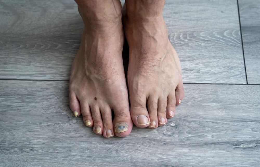 Infected toenails