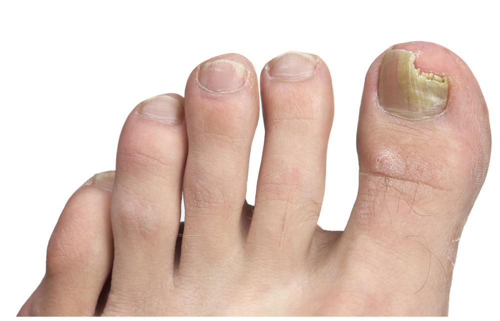 Nail Infection
