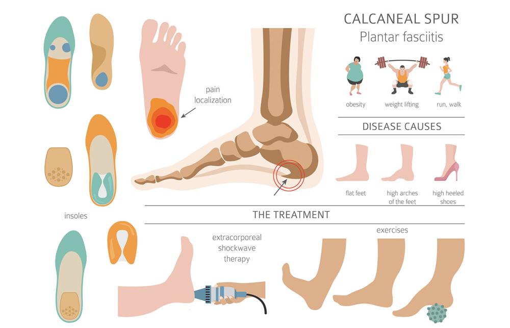 Home Treatments for Plantar Fasciitis