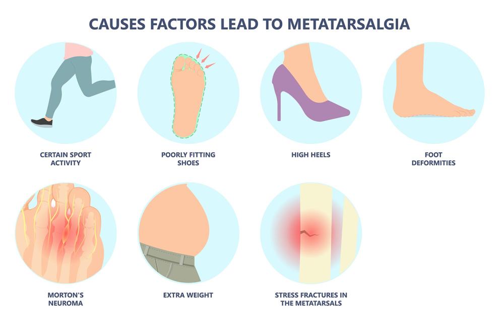 Causes of Metatarsalgia