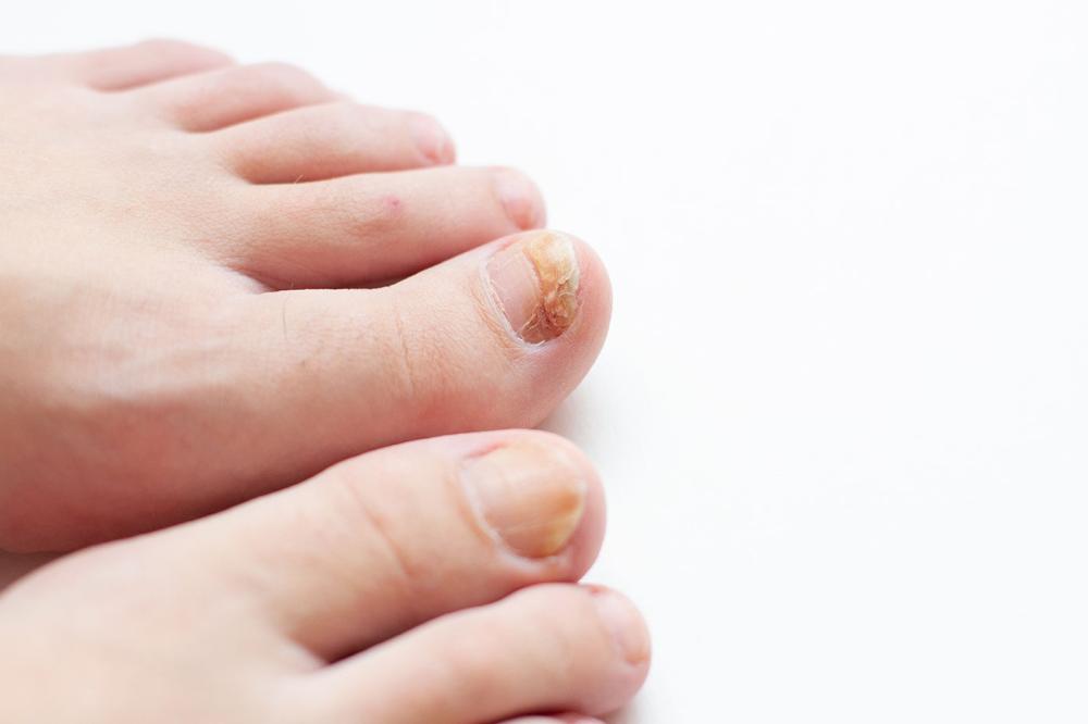Nail fungus Onychomycosis