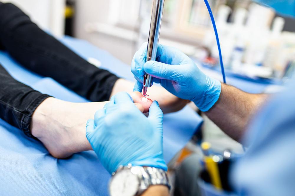 Laser Therapy for Fungal Nail
