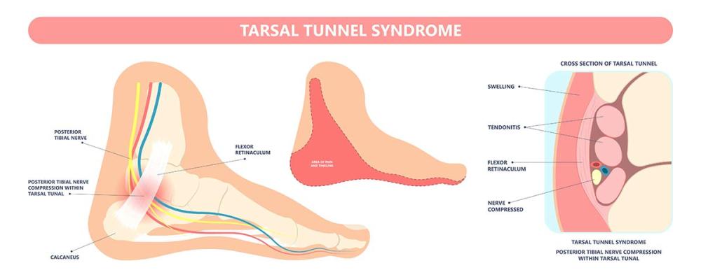 Tarsal Tunnel