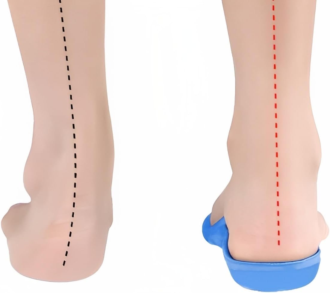 Insoles for High Arches and Supination: 2 Practical Solutions