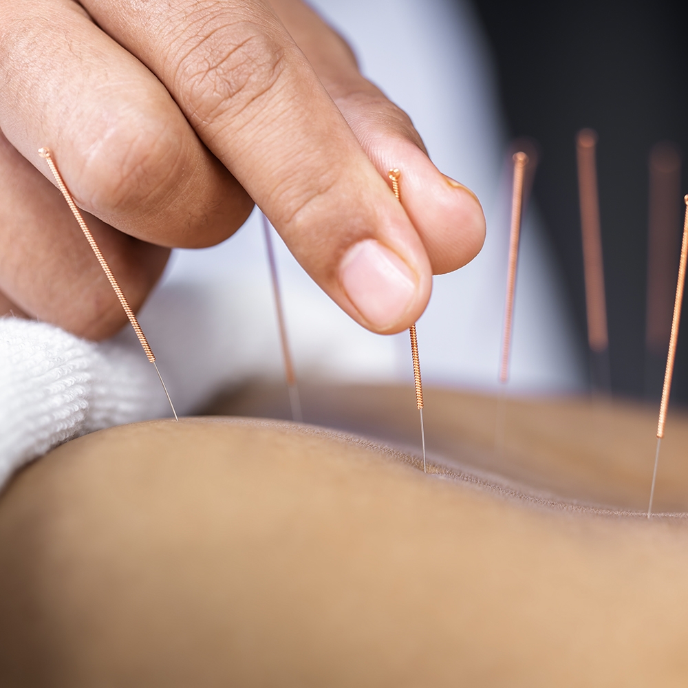 Acupuncture Supplies | Big Savings with Epic Points