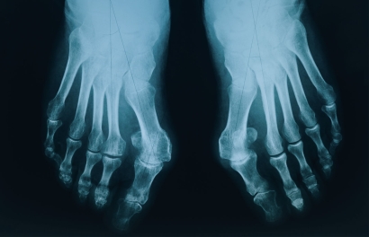 Bunion Treatment for Podiatrists