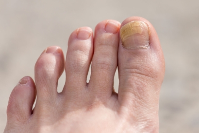 Fungal Nail